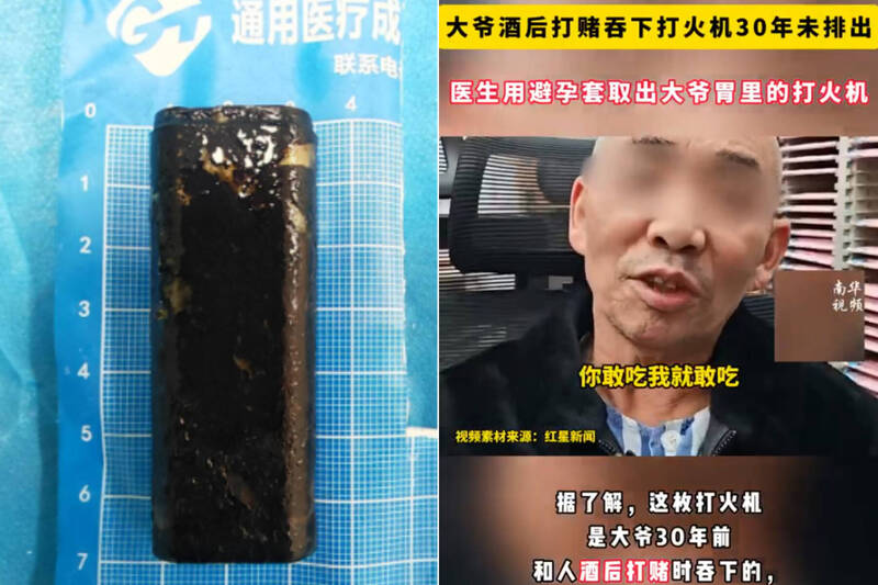 通博娛樂城-國際新聞-【胃裡藏玄機!】中國阿伯腹痛照胃鏡!醫護全嚇傻:「打火機」藏了30年還能用!
