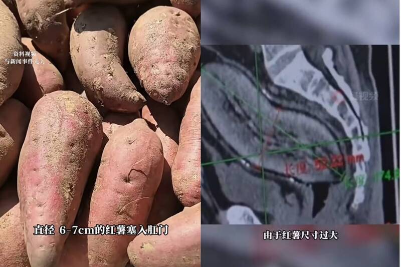 真的沒在開玩笑！61歲大爺深夜往肛門塞「17公分巨型地瓜」，醫護看傻眼：腸子差點被撐爆！